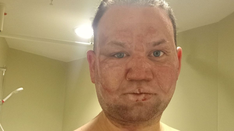 Fire-Breather's Face 'Melts' Off in BBQ Blaze Gone Wrong