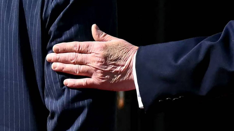Trump's Health Under Fire: New Bruises Spark 'Rotting' Speculation