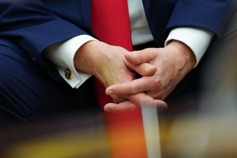 Trump's Bruised Hands and Makeup: Terminal Illness Rumors Ignite